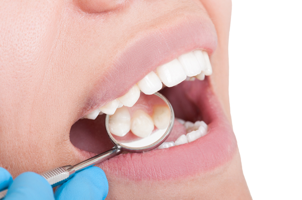 Signs You May Need A Deep Teeth Cleaning