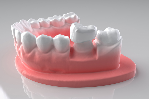 Common Issues With Dental Crowns And How To Fix Them
