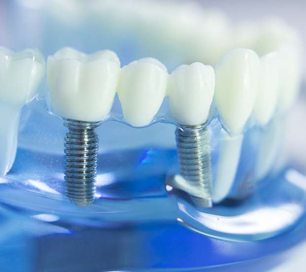 Mooresville Dental Implants
