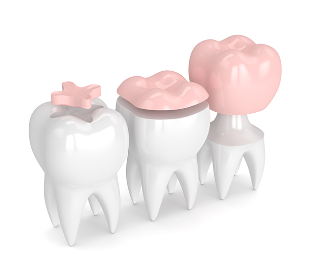 Mooresville Dental Inlays and Onlays