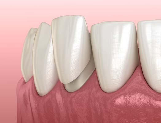 Restore Your Smile With Dental Veneers