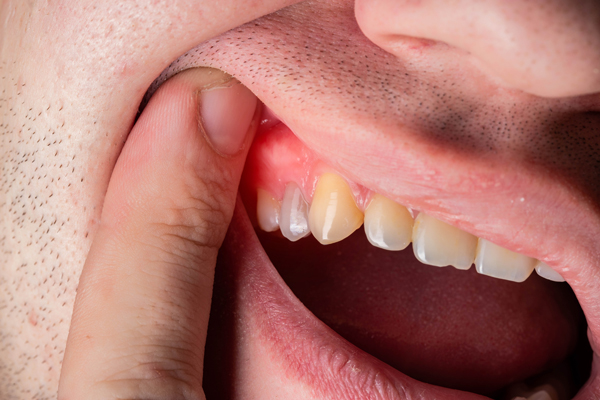 What Causes Periodontal Disease?